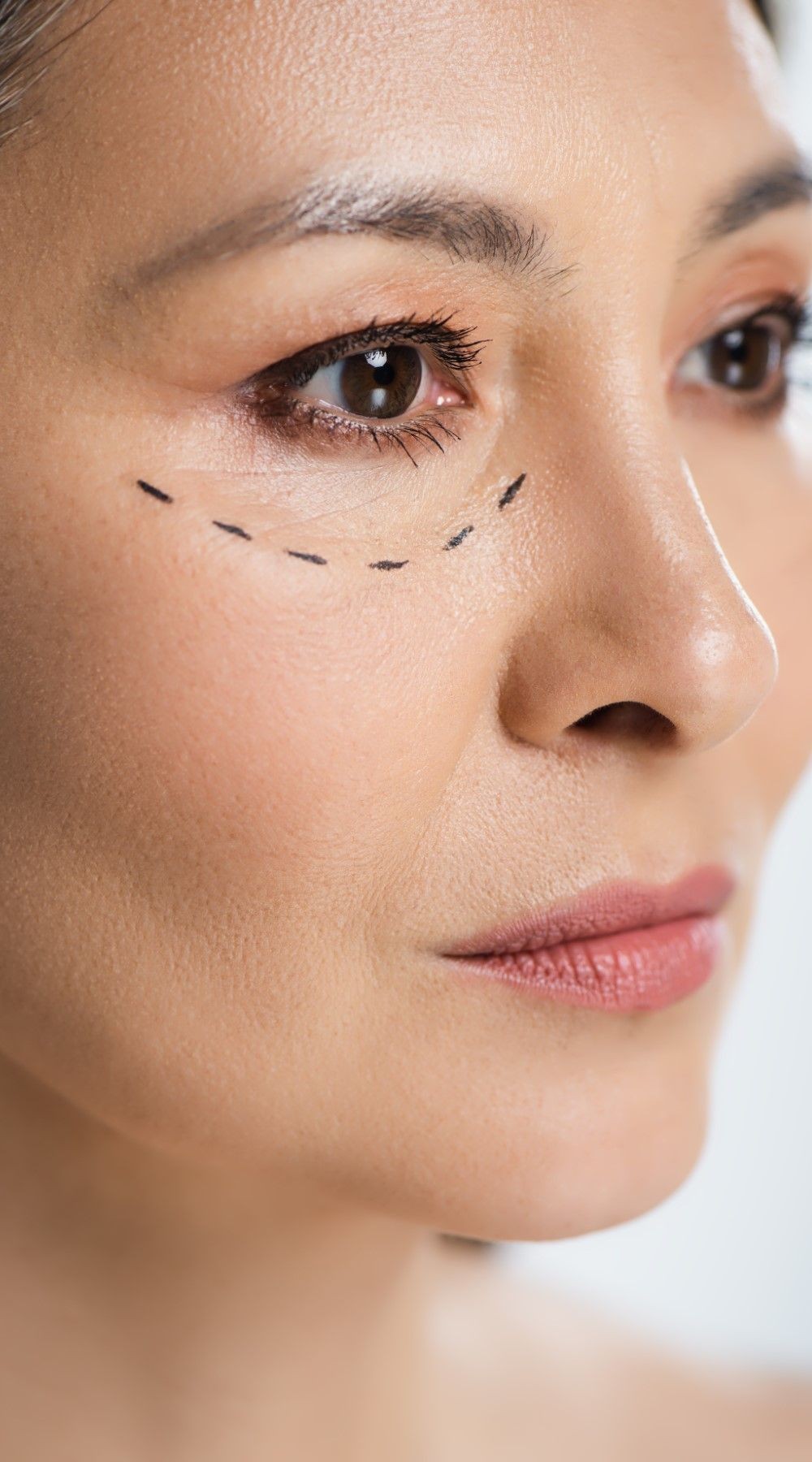 Imagen donde se puede ver el rostro de una mujer con marcas para saber en donde se realizará la blefaroplastia adecuadamente.