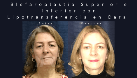  Imagen en que se muestra la comparación del antes y después de un procedimiento de lipotransferencia en mujer de edad media.