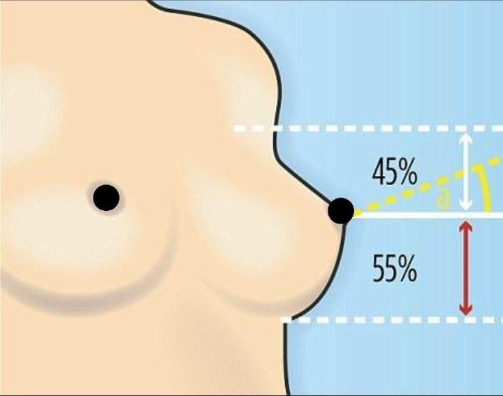Ilustración de cuanto aumenta el busto con una operación de aumento de busto con grasa en PARS