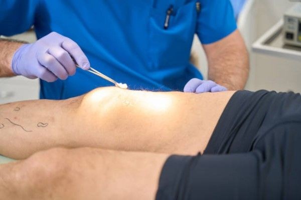 imagen con acercamiento detallado a las piernas de una paciente mientras el especialista realiza la preparación previa a una lipoescultura, marcando áreas específicas para eliminar grasa localizada