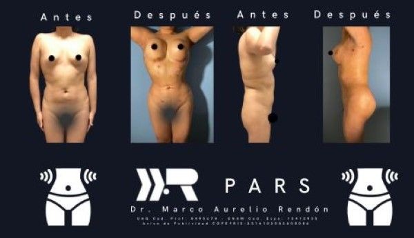 Imagen representativa en donde se ve una recopilación de pacientes de lipoescultura precio en la parte inferior del cuerpo.