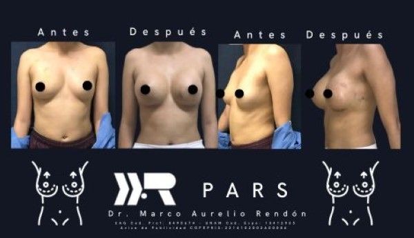  Imagen representativa en donde se ve una recopilación de pacientes de lipoescultura precio en la parte superior del cuerpo.