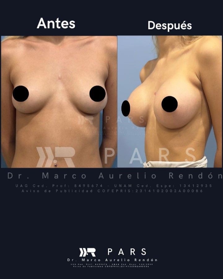 fotografía del Antes y después de una operación de aumento de busto con grasa en PARS