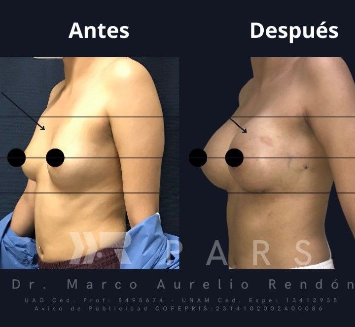 Fotografía de la Vista lateral del antes y después de un aumento de busto de una mujer en PARS