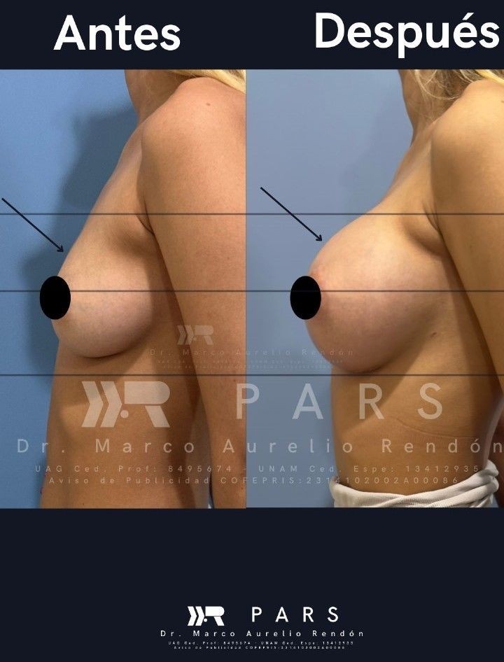 fotografía lateral del Aumento de busto con grasa que se realiza en PARS