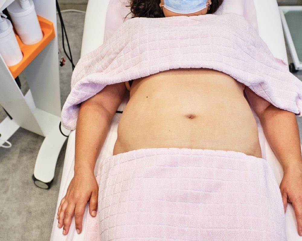 Vista clínica del abdomen de mujer lista para intervención estética por cirujano plástico certificado.