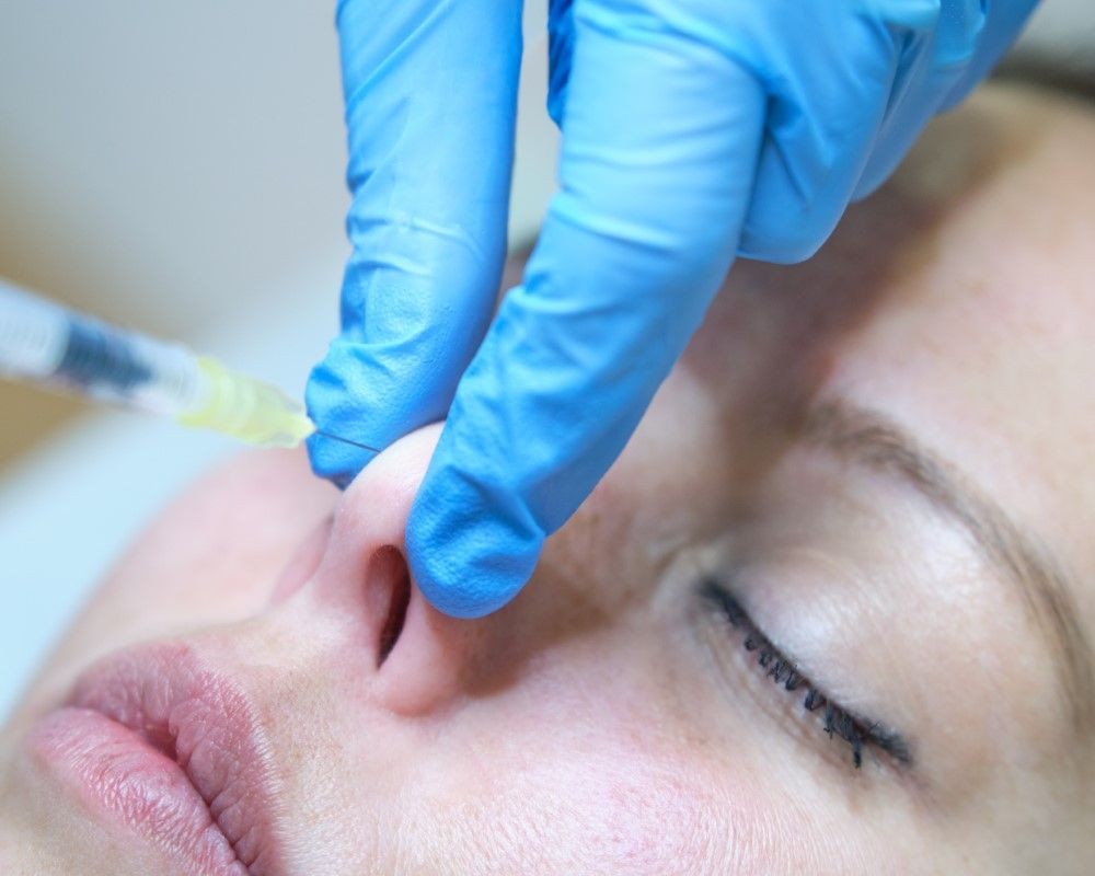Inicio del procedimiento de rinoplastia estética realizada por cirujano plástico certificado en Guadalajara.