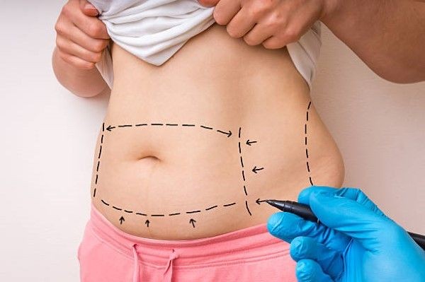 imagen donde un cirujano plástico especializado en lipoescultura realiza con marcador quirúrgico el diseño de contorno abdominal en el cuerpo de una paciente antes del procedimiento