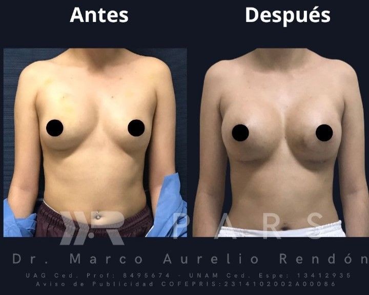 Fotografía del antes y después del aumento de busto de una mujer en PARS