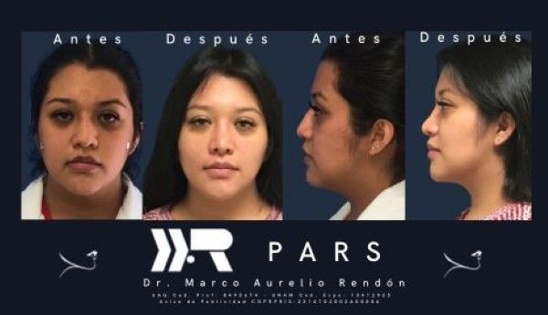 Dos pacientes que han recibido un procedimiento exitoso de rinoplastia precio en una imagen de comparación antes y después.